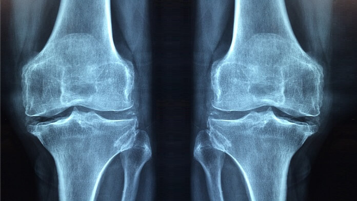 Simptomele Picioarelor Artritei Reumatoide - Artrita reactivă